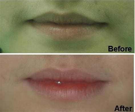 Dark Lips Laser Treatment Before And After Lipstutorial Org