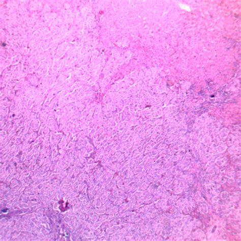 Bladder Cancer Prepared Slides Of Human Pathology Xinxiang Happy