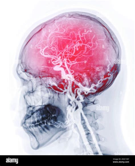 Cta Brain Or Ct Angiography Of The Brain 3d Rendering Image Fusion With