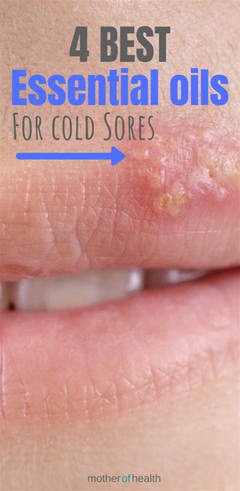 The 4 Best Essential Oils For Cold Sores Mother Of Health