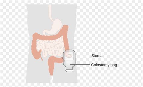 Colostomy Stoma Ileostomy Surgery Ostomy Pouching System Hinh Nen Co