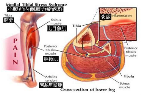 【跑步科學】小心過度訓練，脛骨挫傷知多啲！ ｜ 運動筆記hk