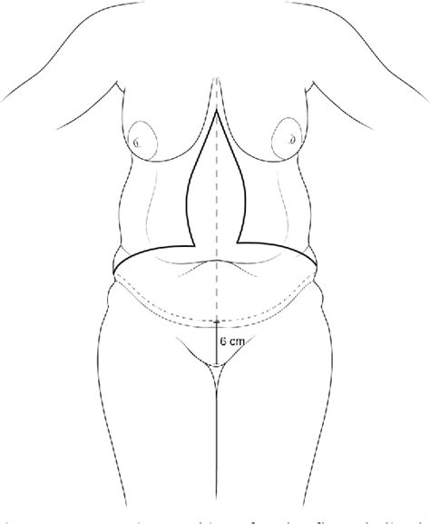 Figure 1 from The Fleur-De-Lis abdominoplasty. | Semantic Scholar