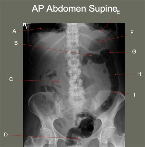 Abdomen Supine Diagram Quizlet