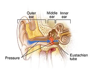 Understanding Ear Barotrauma | Saint Luke's Health System