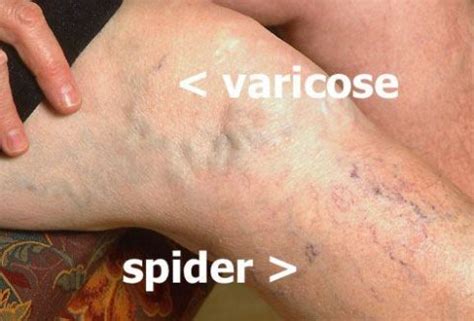 Spider Veins Or Varicose Veins What Is The Difference