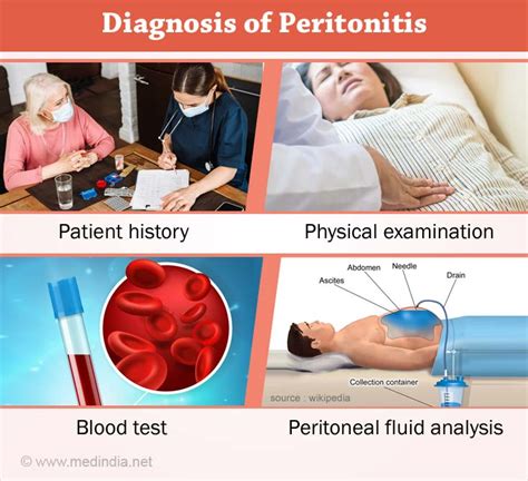 Peritonitis - Causes, Symptoms, Complications, Diagnosis, Treatment ...