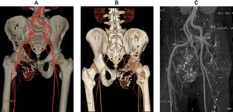 Example Of Osteosarcoma Reconstruction By Volume Rendered 3D CTA Image