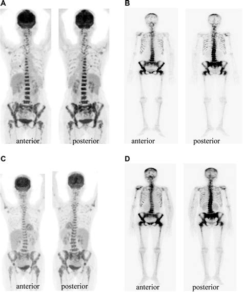 At Initial Diagnosis Of Recurrent Breast Cancer 18 F FDG PET CT And