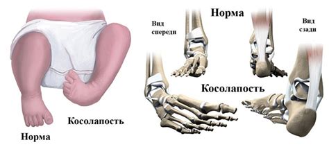 какую обувь носить при косолапости детям