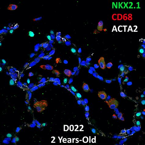 Year Old Human Lung Confocal Imaging Donor D Nkx Cd And Acta