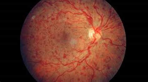 Retinal Vein Occlusion: Symptoms, Treatment and Prevention