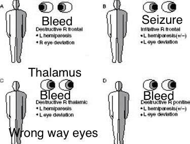 Oren Gottfried Md On Twitter Let The Eye Deviation Help You Localize