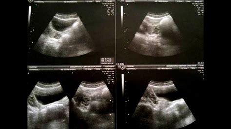 La extraña historia de una mujer que nació sin vagina