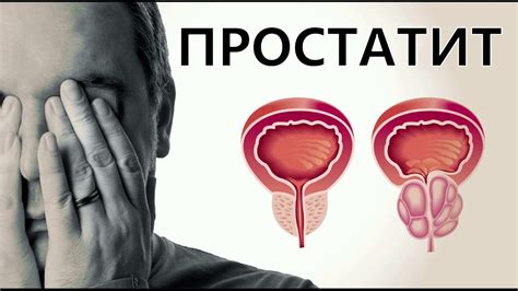 Причины простатита. Аденома простаты. Что важно знать про простатит ...