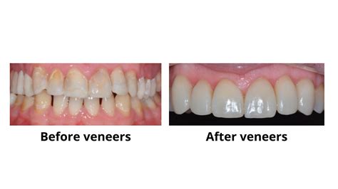 How to fix worn down front and back teeth (2 steps with pictures)