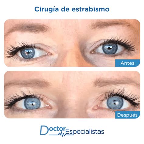 Mejores Oftalmologos Para Cirugia De Estrabismo Doctor Especialistas