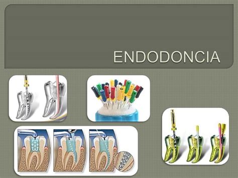 Endodoncia Pasos Simples