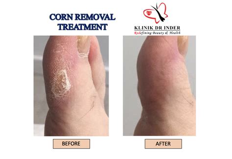 Corn Removal Laser Treatment Aesthetic Clinic Klinik Dr Inder