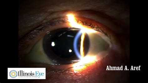 Eye Examination Of A Cataract Youtube