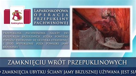 Laparoskopowa Operacja Przepukliny Pachwinowej Youtube