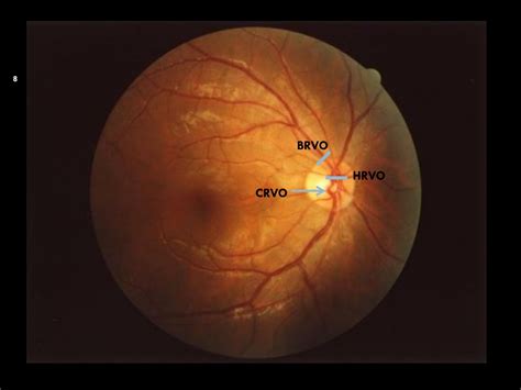 PPT - Occlusive vascular disorders of the retina- CRVO Ayesha S