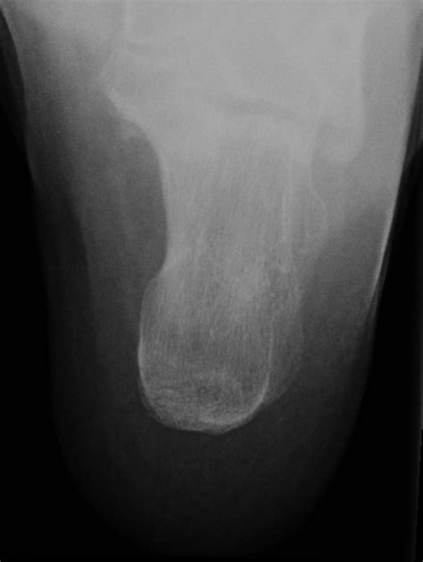 Haglund Deformity Image