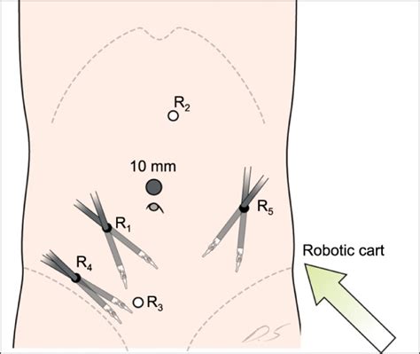 Setup For The Pelvic Phase In A Robotic Lateral Pelvic Node Dissection