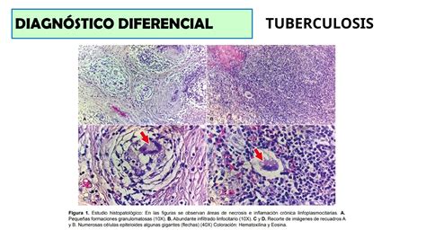 Mastitis Granulomatosa Diagn Stico Ecogr Fico Ppt