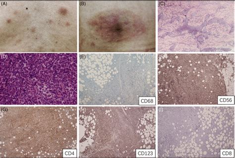 A The Patient A 58‐year‐old Male Had Multiple Erythematous