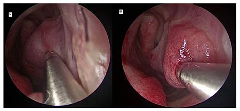 Ijerph Free Full Text Surgical Interventions For Inferior Turbinate