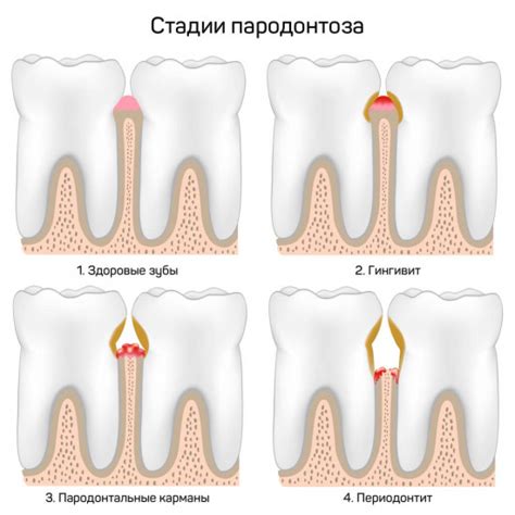 Пародонтит - лечение воспаленных тканей пародонта в Лёгкой стоматологии