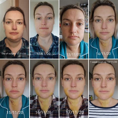 1 week of LJS post-op recovery progress. Swelling has gone down a ton