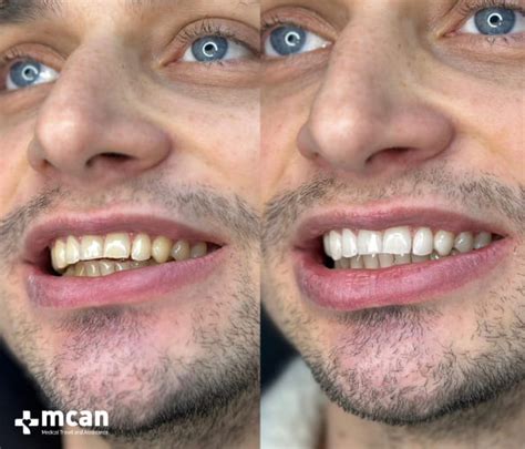 Teeth Whitening Turkey | Proven Results, Reviews, Prices