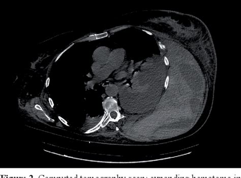 Figure 2 From A Case Of Acquired Factor Xiii Deficiency Secondary To Plasmablastic Lymphoma