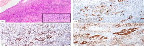 Microscopic Sertoliform Sex Cord Proliferations A Rare Inci