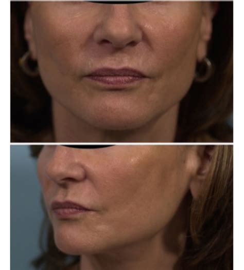 Facelift Before And After Case 1 Beverly Hills CA Moy Fincher Chipps