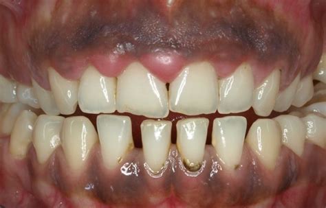 C Mo Tratar Las Enc As Negras O Melanosis Gingival