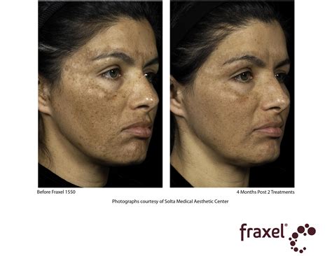 Fraxel Laser Treatment Cost Results Studiomd Mendham New Jersey