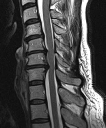 Bandscheibenvorfall Der Halswirbels Ule Hws Therapie Op