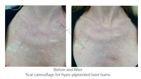 Permanent Camouflage Makeup For Scars Saubhaya Makeup