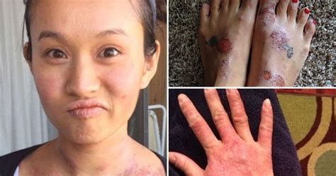 Woman Reveals How Boob Job Left Her With Eczema So Severe She Was Suicidal And Unable To Have