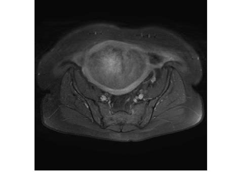 After Contrast Administration Axial T2 Weighted Mr Image Shows An Download Scientific Diagram