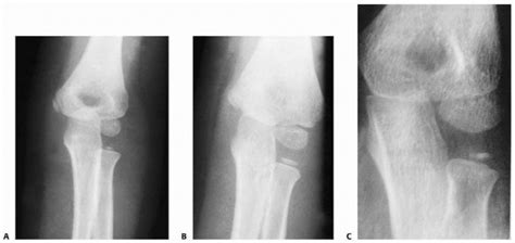 Radial Head Teachme Orthopedics