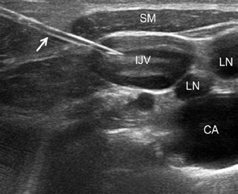 External Jugular Vein Cannulation