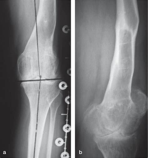 Standing Weightbearing Radiographs Of The Left Leg In A 36 Year Old