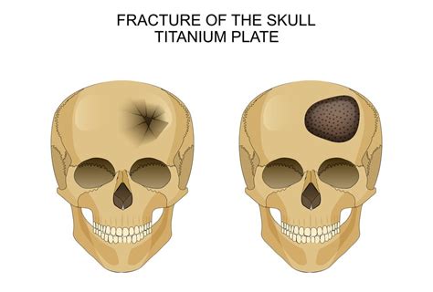 Skull Fractures Types Symptoms Causes Treatment Zealmax