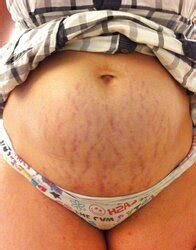 Vergeture Grossesse ZB Porn