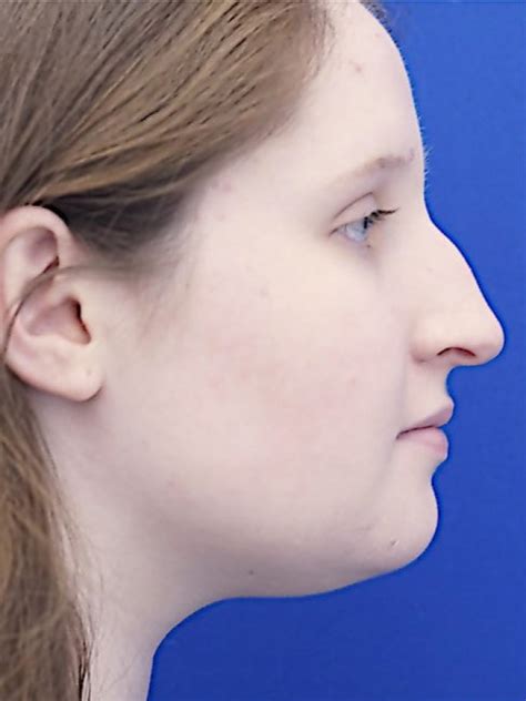 Reduction Dorsal Hump Mao Facial Plastics