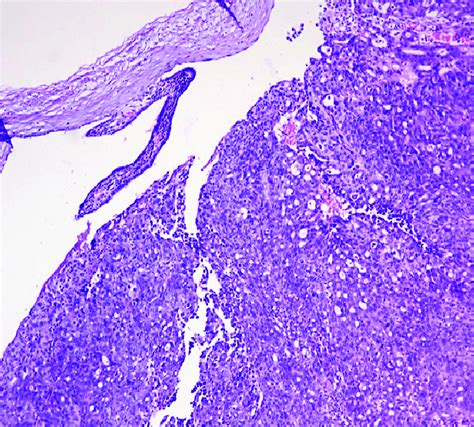 High Grade Serous Carcinoma Of Fallopian Tube H And E X